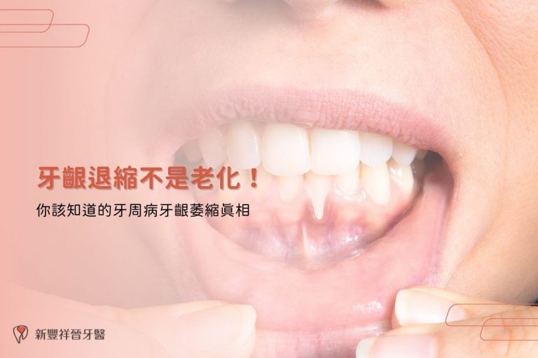 牙齦退縮不是老化！你該知道的牙周病牙齦萎縮真相