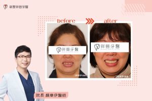 全口咬合重建01