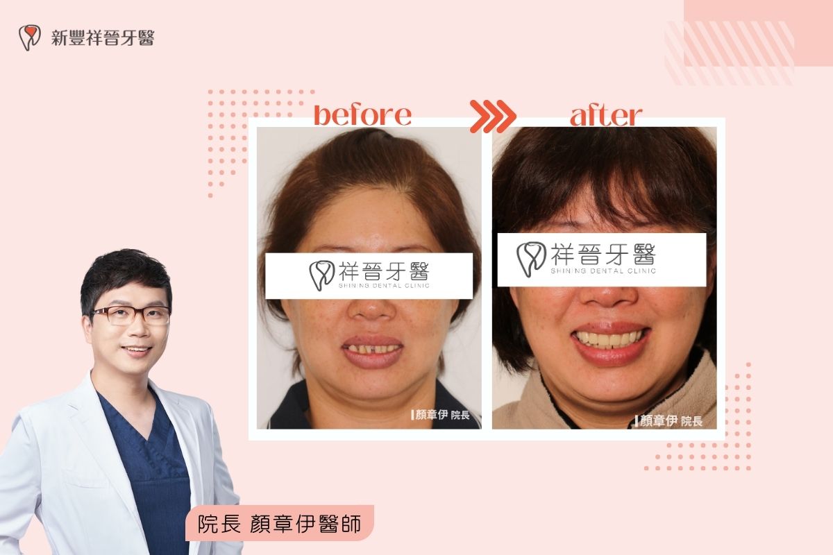顏章伊院長 全口重建・矯正＋全口假牙 案例 治療前後對照（新豐祥晉牙醫）