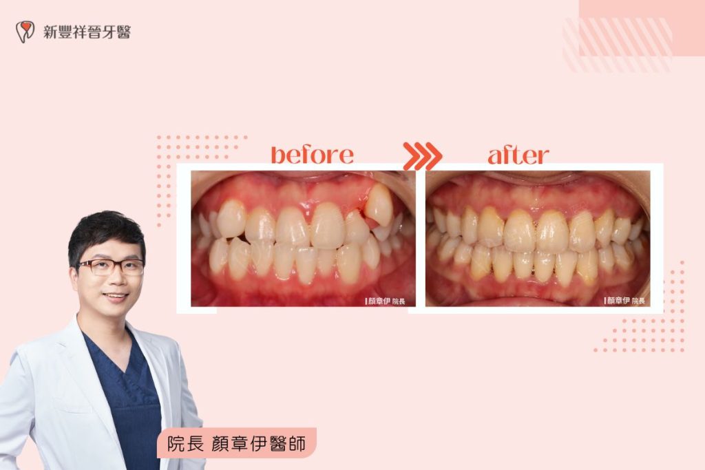 隱適美矯正｜牙齒擁擠、虎牙厚道案例