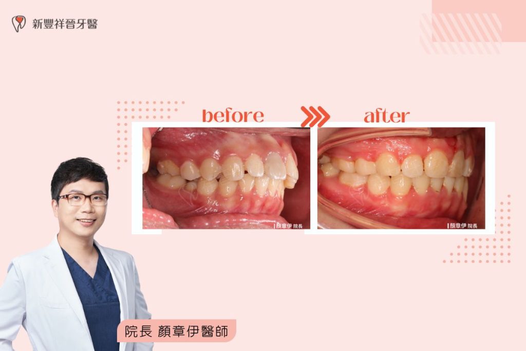 隱適美矯正｜嘴突案例