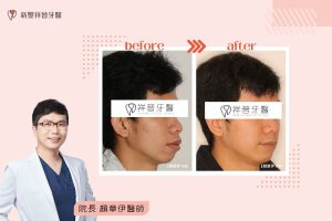 隱適美矯正｜嘴突、暴牙案例