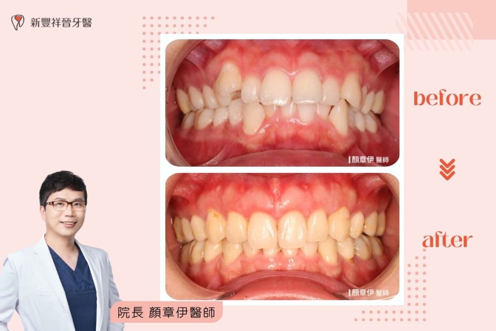 隱適美矯正09-1