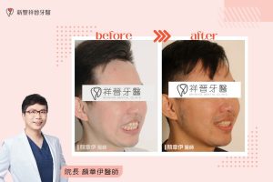 隱適美矯正10-1