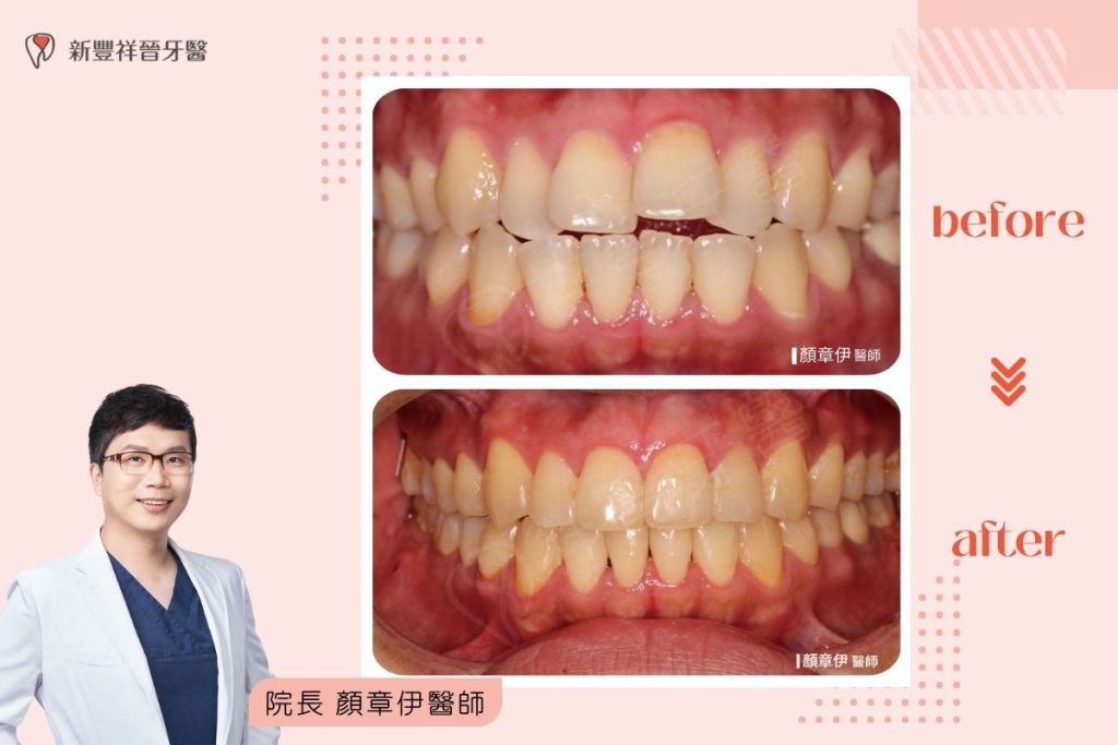 隱適美矯正10-2