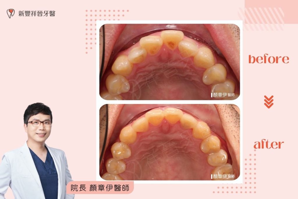 隱適美矯正10-3