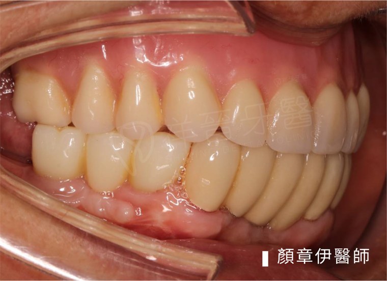 BPS吸附式活動假牙治療後口內照|顏章伊醫師案例