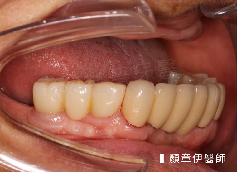BPS吸附式活動假牙治療前口內照|顏章伊醫師案例