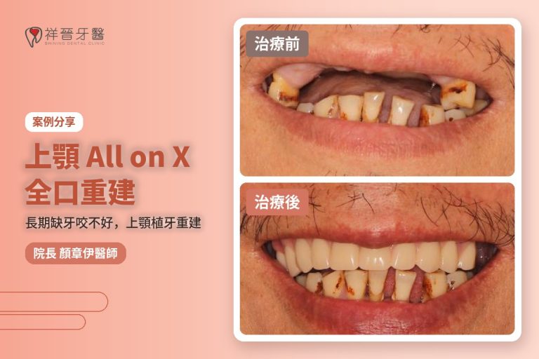 上顎All on X全口重建案例 治療前後對比 顏章伊院長|新豐祥晉牙醫