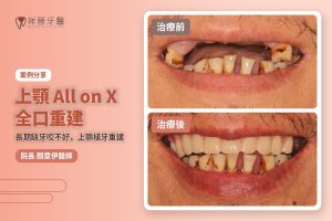 上顎All on X全口重建案例 治療前後對比 植牙專科顏章伊院長|新豐祥晉牙醫