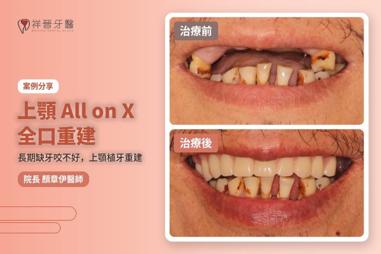 上顎All on X全口重建案例 治療前後對比 植牙專科顏章伊院長|新豐祥晉牙醫