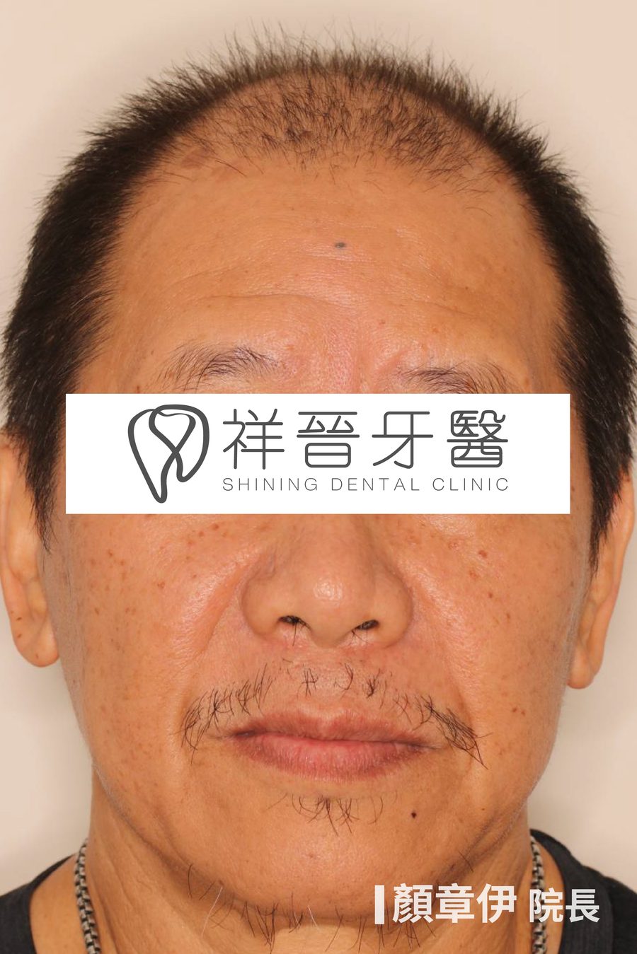 長期缺牙治療前 正面 上顎All on X案例 顏章伊院長 祥晉牙醫
