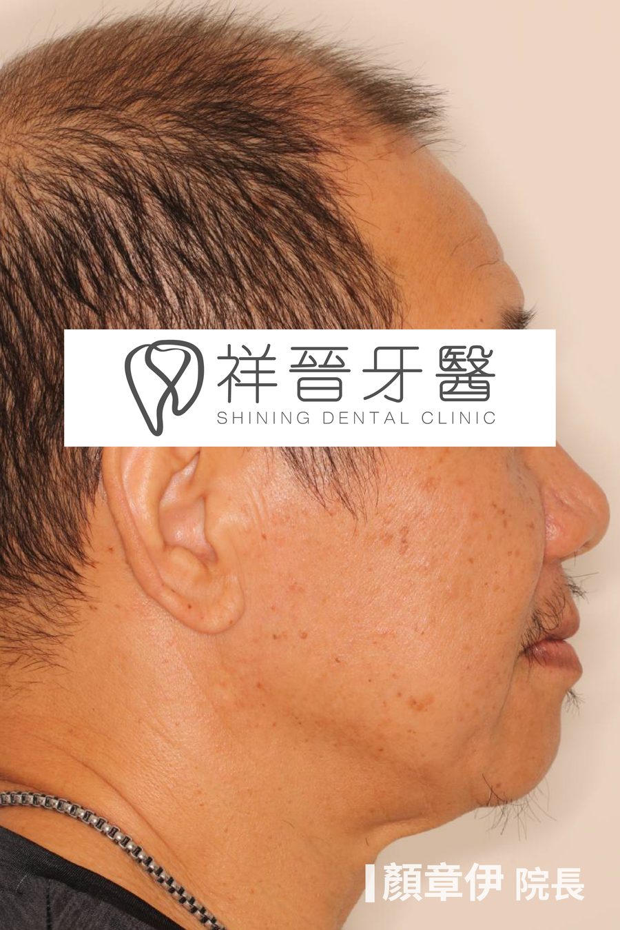 長期缺牙治療前 側面 上顎All on X案例 顏章伊院長 祥晉牙醫