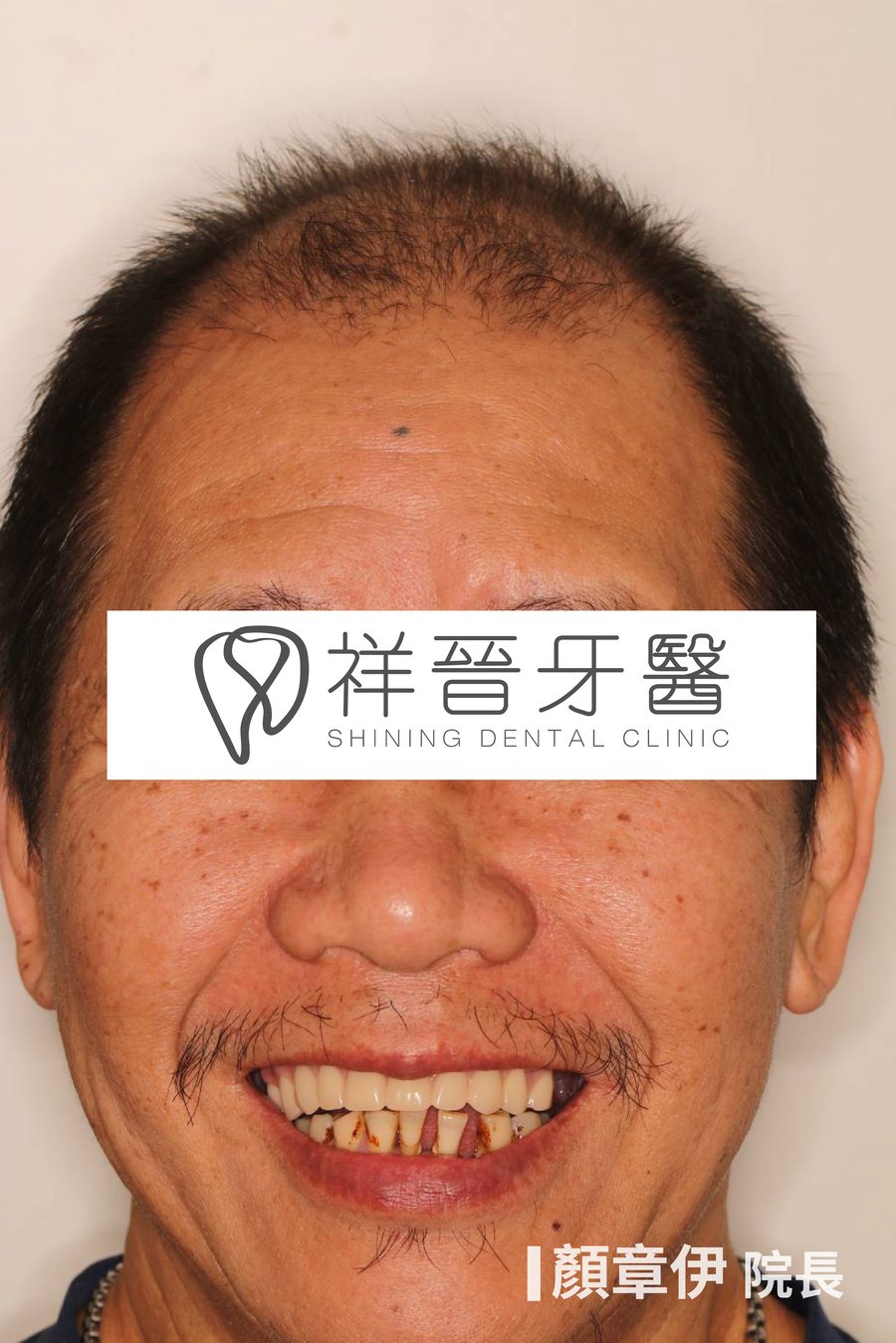 上顎All on X重建治療後 微笑正面 顏章伊院長 祥晉牙醫
