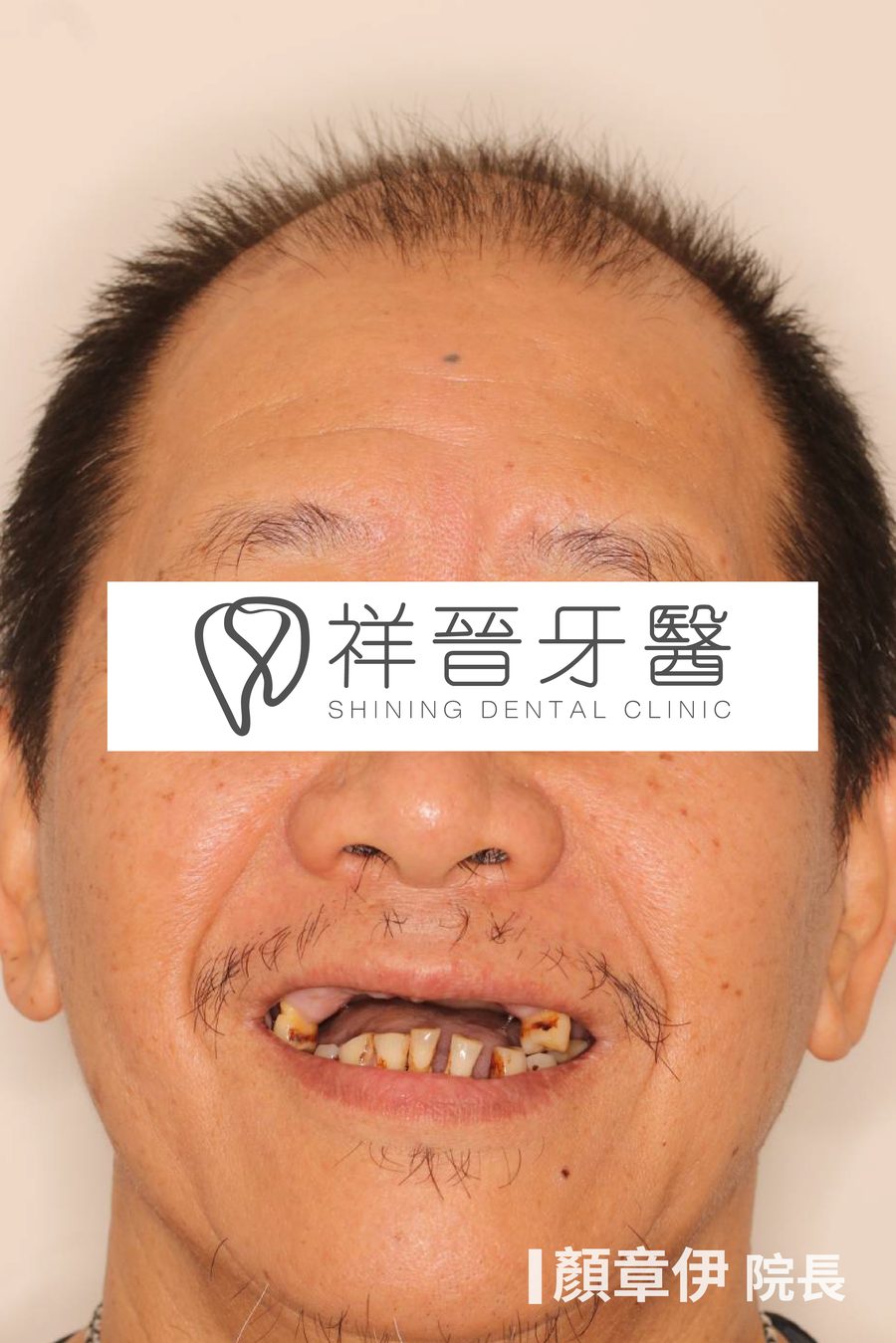 上顎缺牙治療前 微笑正面 上顎All on X案例 顏章伊院長 祥晉牙醫