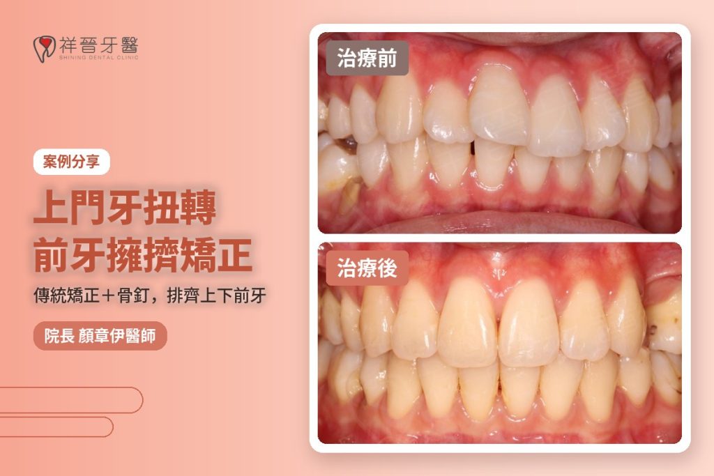 上門牙扭轉 前牙擁擠矯正案例 傳統矯正加骨釘 治療前後對比 顏章伊院長｜新豐祥晉牙醫