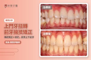 上門牙扭轉 前牙擁擠矯正案例 傳統矯正加骨釘 治療前後對比 顏章伊院長｜新豐祥晉牙醫