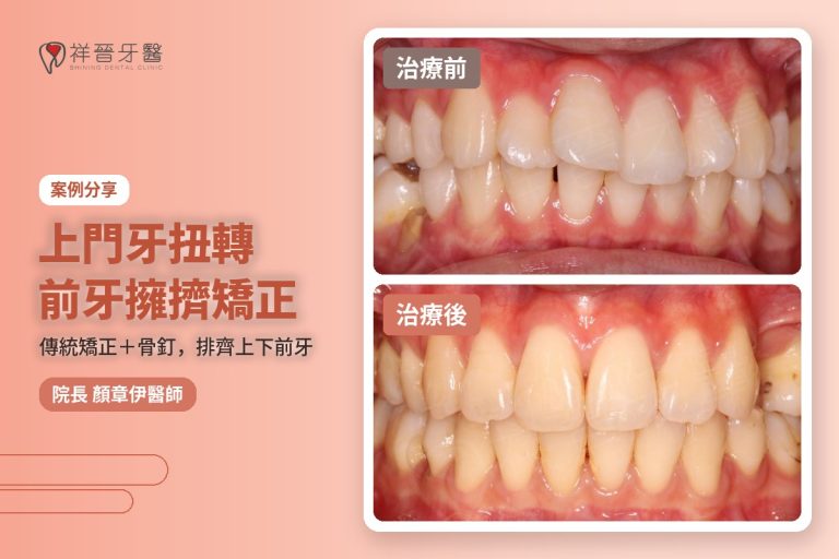 上門牙扭轉 前牙擁擠矯正案例 傳統矯正加骨釘 治療前後對比 顏章伊院長|新豐祥晉牙醫