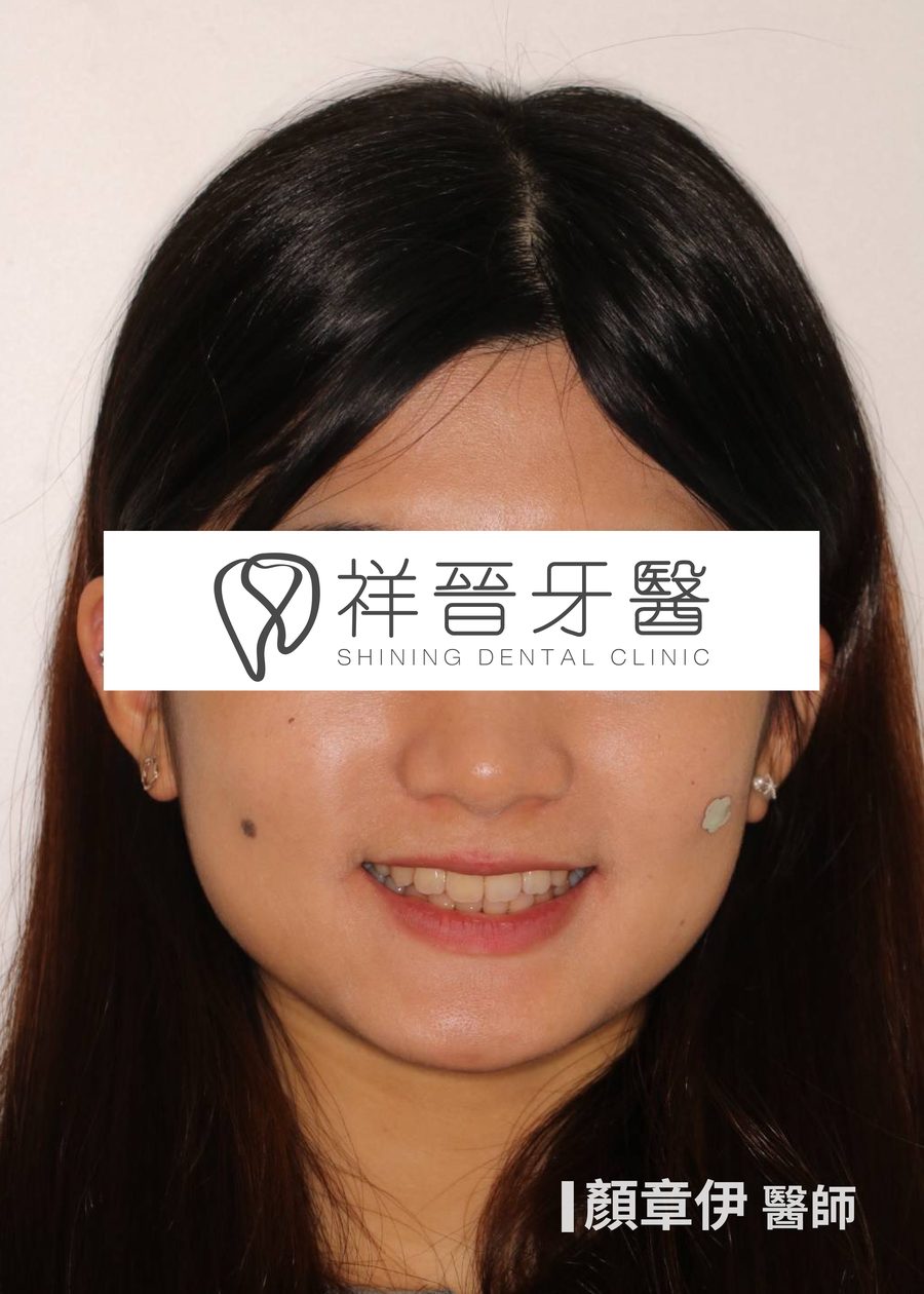 矯正後 正面微笑 顏章伊院長 祥晉牙醫