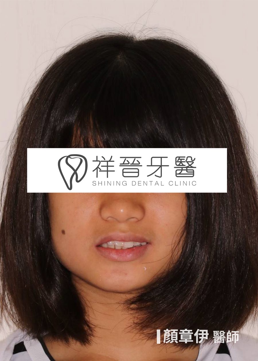 前牙擁擠 矯正前 正面微笑 顏章伊院長 祥晉牙醫