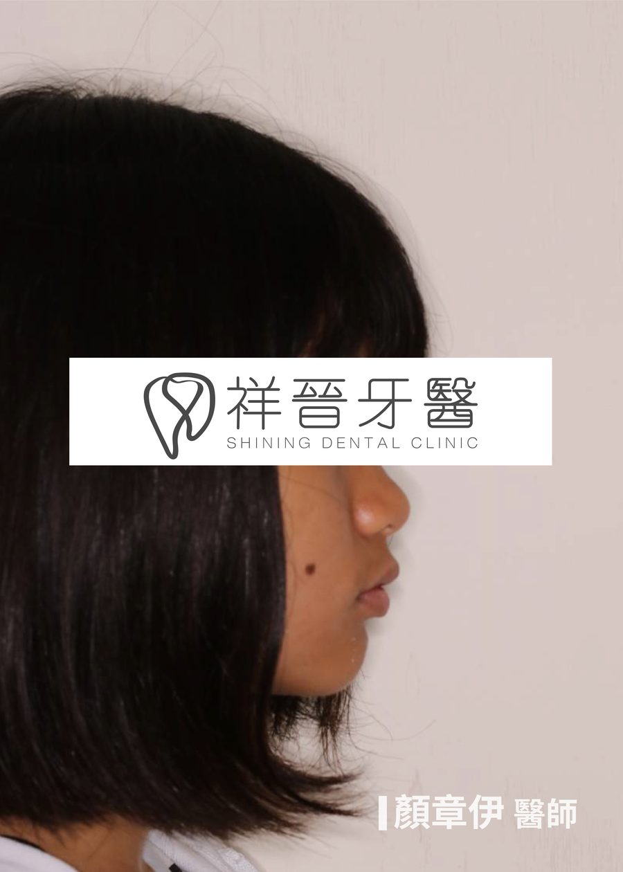 矯正前 側臉 顏章伊院長 祥晉牙醫