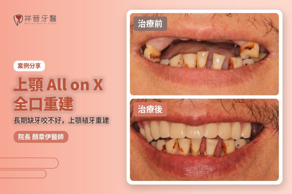 上顎All on X全口重建案例 治療前後對比 植牙專科顏章伊院長｜新豐祥晉牙醫