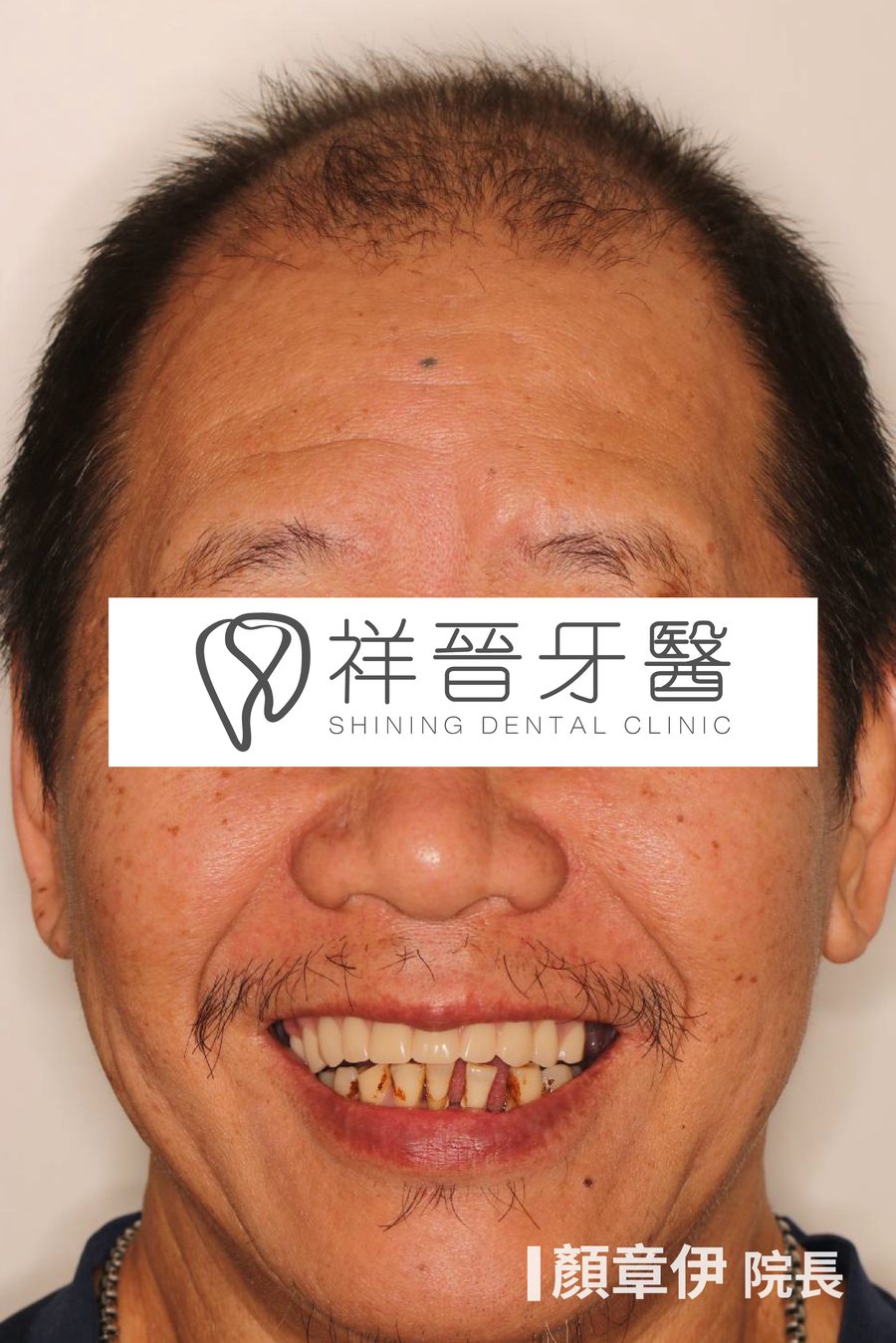 上顎All on X重建治療後 微笑正面 顏章伊院長 祥晉牙醫