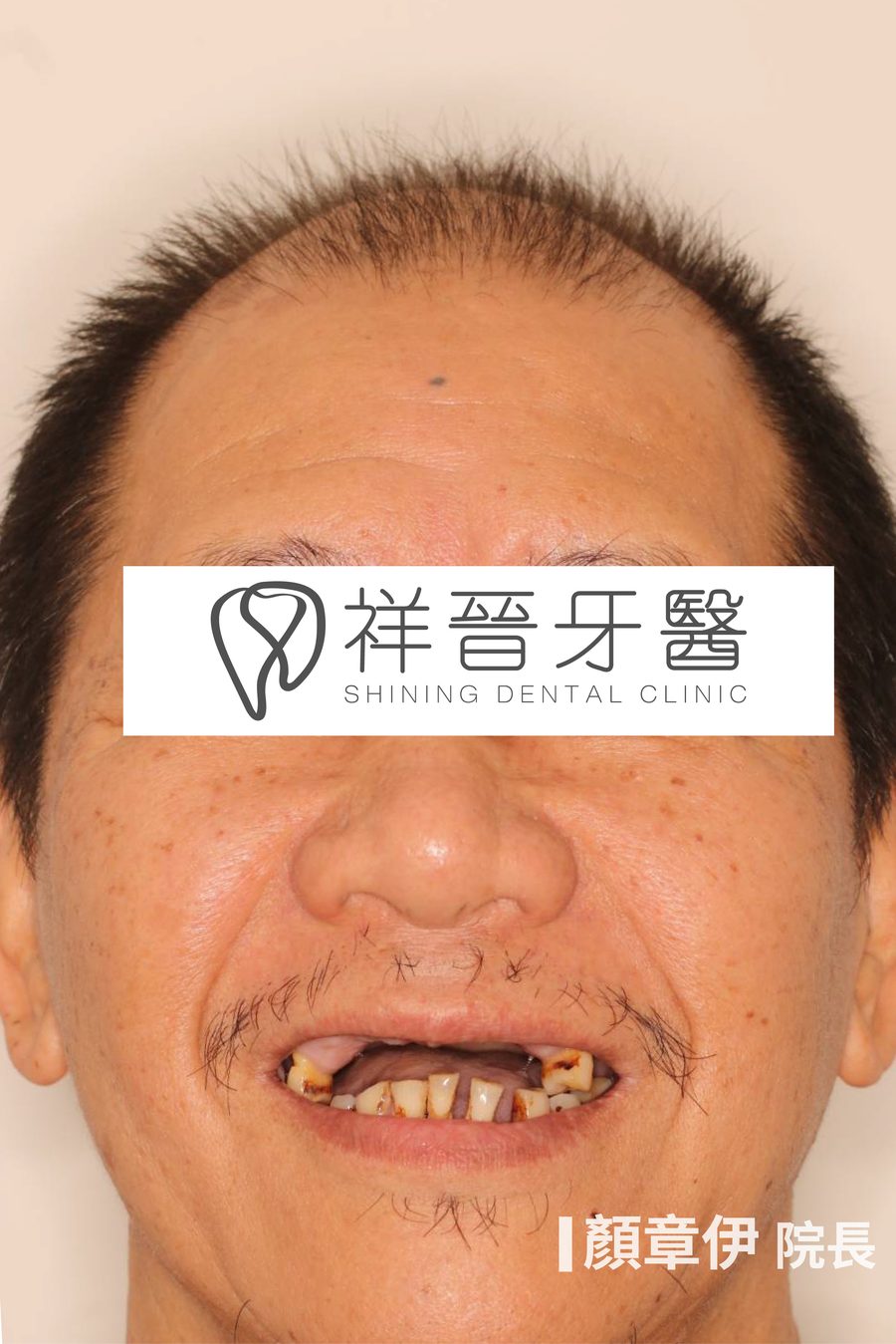 上顎缺牙治療前 微笑正面 上顎All on X案例 顏章伊院長 祥晉牙醫