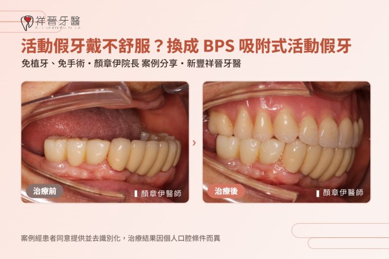 BPS 吸附式活動假牙案例 治療前後口內對照 顏章伊院長 新豐祥晉牙醫