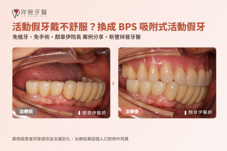 BPS 吸附式活動假牙案例 治療前後口內對照 顏章伊院長 新豐祥晉牙醫
