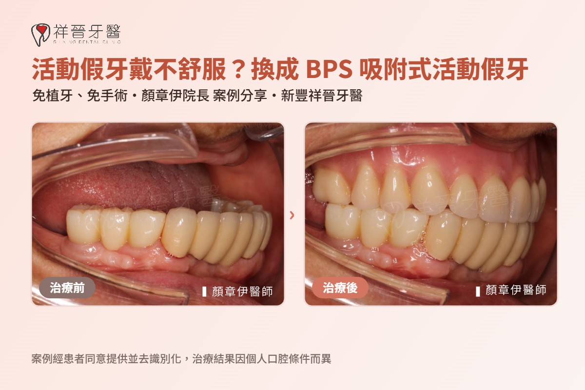 BPS 吸附式活動假牙案例 顏章伊院長 新豐祥晉牙醫