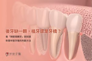 後牙缺一顆,植牙還是牙橋?看「隔壁兩顆牙」就知道|新豐祥晉牙醫