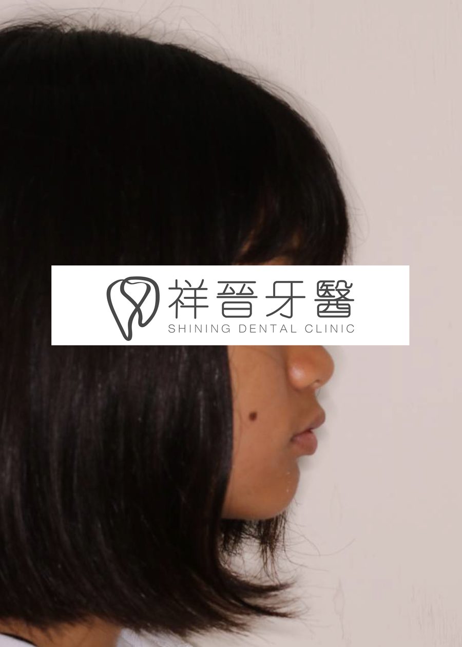 矯正前 正側臉 顏章伊院長 祥晉牙醫